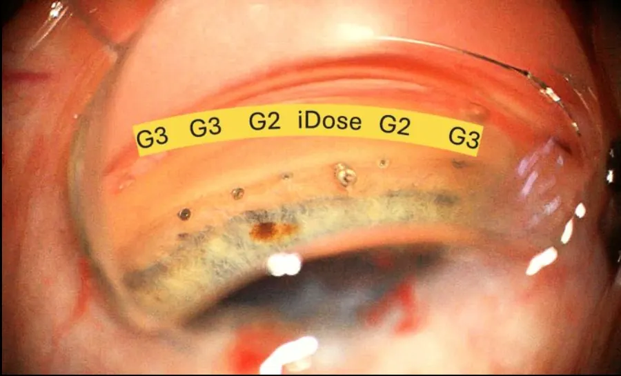 Gonioscopic view showing iStent infinite stents alongside an iDose TR implant