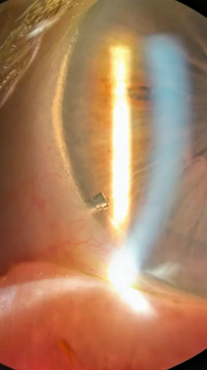 Gonioscopic view of an iDose TR implant anchored in the drainage angle