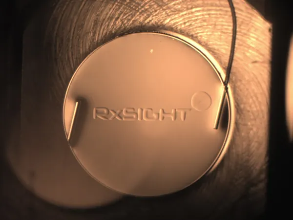 Light Adjustable Lens (LAL) lens implant